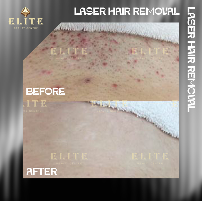 HAIR REMOVAL LASER